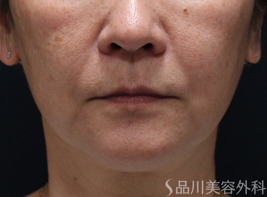 症例NO.73097のBEFORE写真