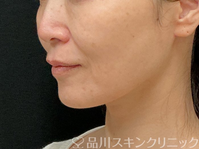 症例NO.74299のBEFORE写真