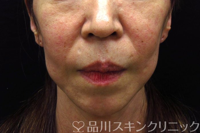 症例NO.74318のBEFORE写真