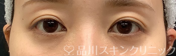 症例NO.69447のAFTER写真