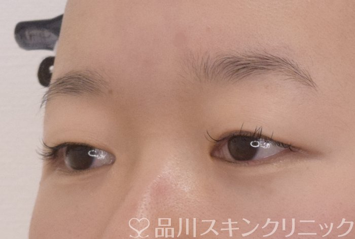 症例NO.69571のBEFORE写真