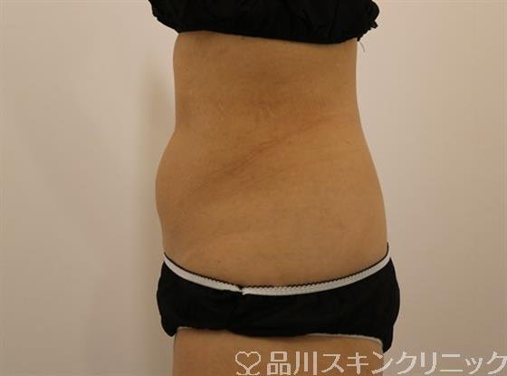 症例NO.43840のBEFORE写真