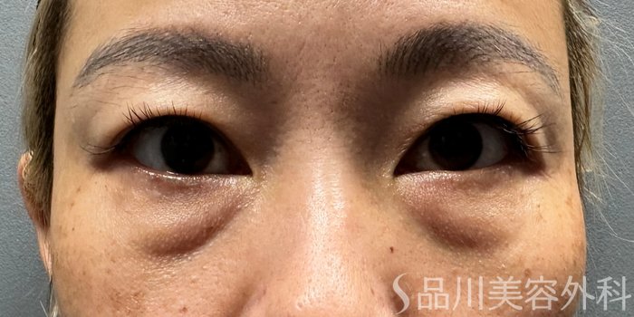 症例NO.65553のBEFORE写真