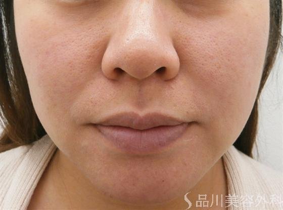 症例NO.13789のAFTER写真