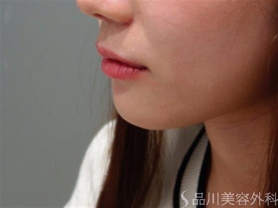 症例NO.50616のBEFORE写真
