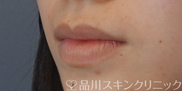 症例NO.72207のBEFORE写真