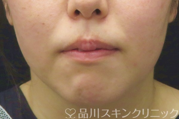 症例NO.63292のBEFORE写真