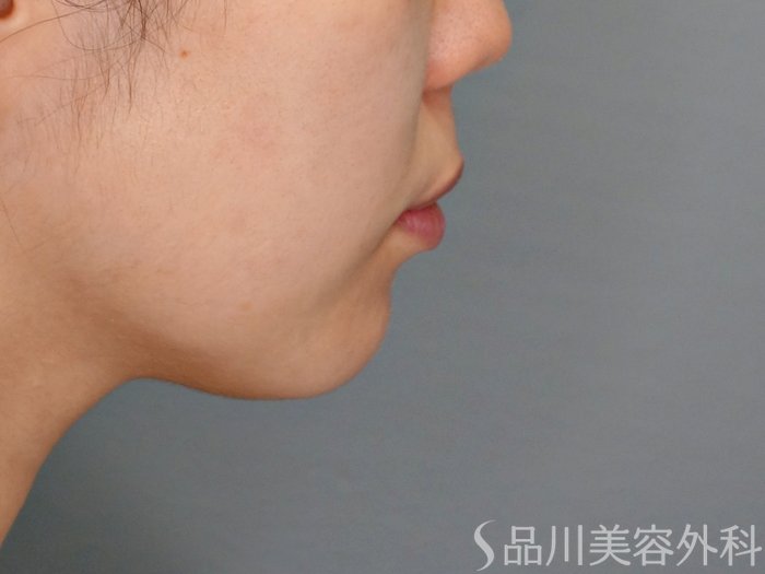 症例NO.69095のBEFORE写真