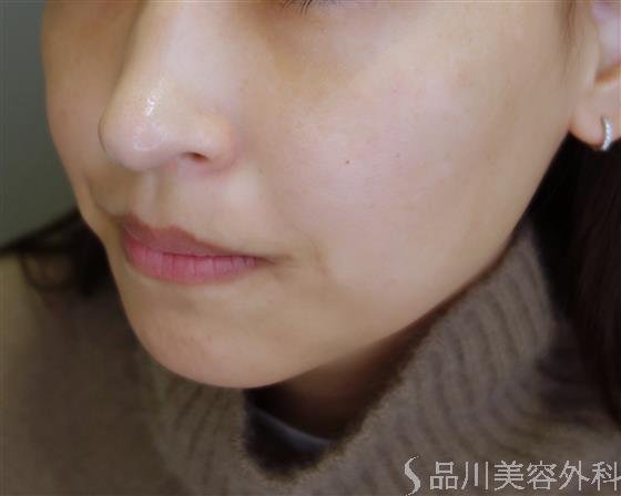 症例NO.49504のBEFORE写真