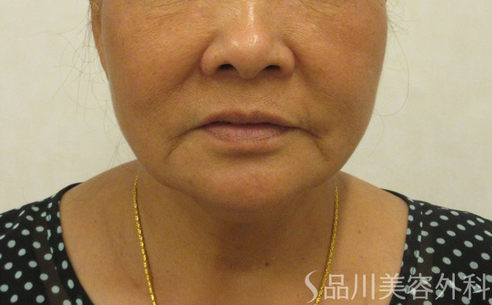 症例NO.72131のBEFORE写真