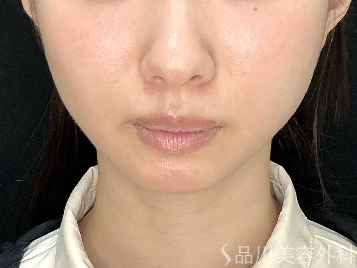 症例NO.71630のAFTER写真