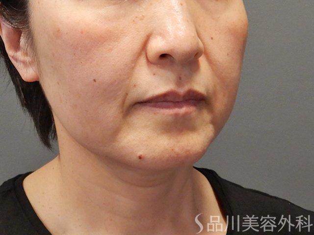 症例NO.75060のBEFORE写真