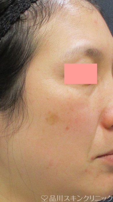 症例NO.70860のBEFORE写真