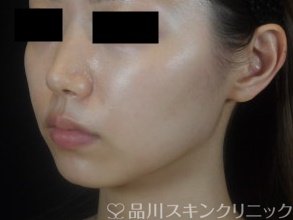 症例NO.74305のBEFORE写真
