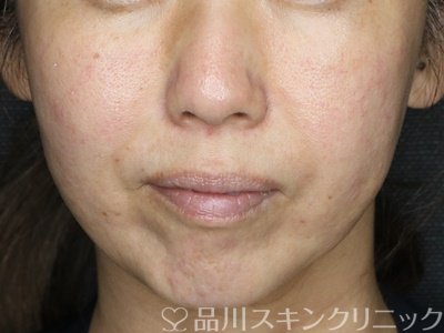 症例NO.73245のAFTER写真