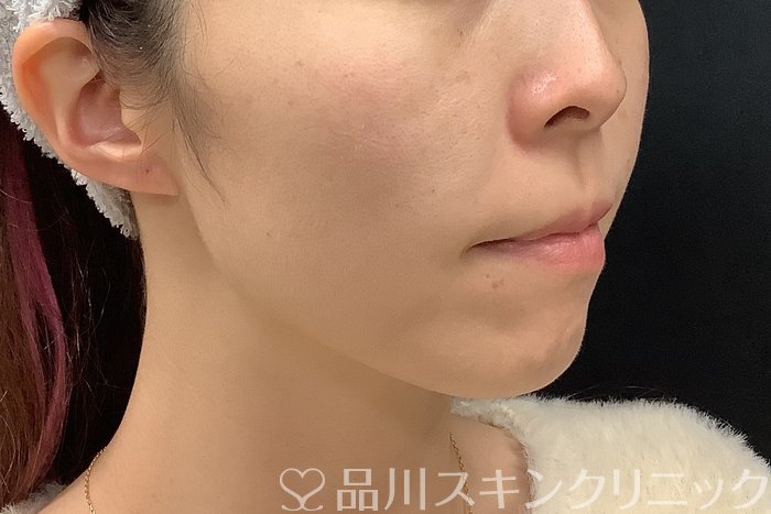 症例NO.69560のAFTER写真