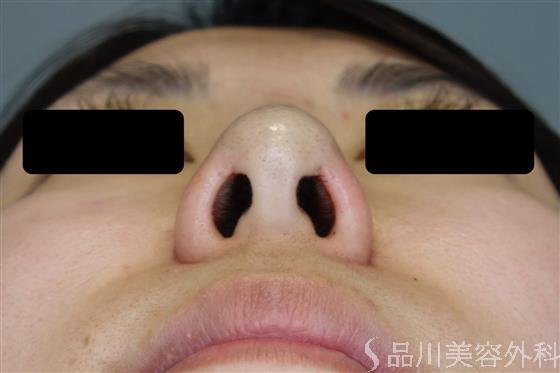 症例NO.50383のAFTER写真