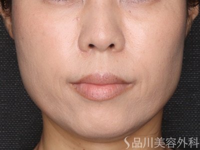 症例NO.72517のAFTER写真