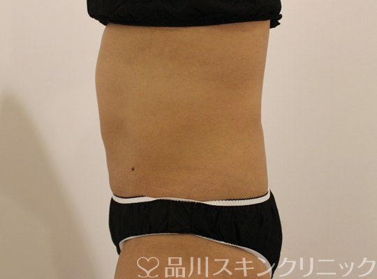 症例NO.69500のAFTER写真