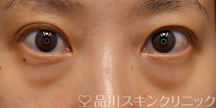 症例NO.74081のBEFORE写真