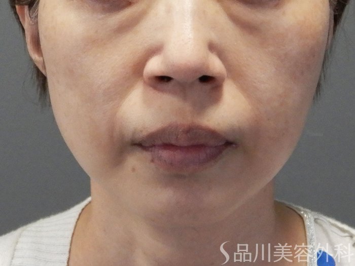 症例NO.72043のBEFORE写真