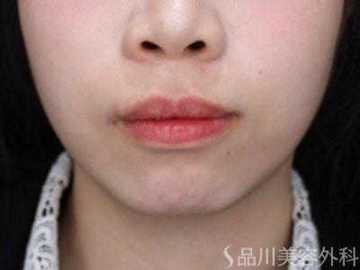 症例NO.72256のBEFORE写真