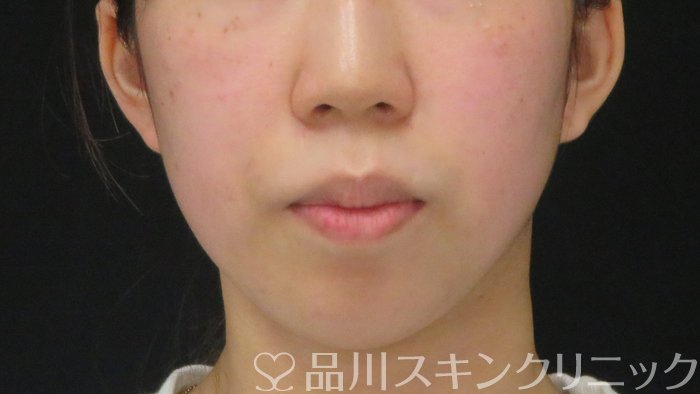 症例NO.72117のBEFORE写真