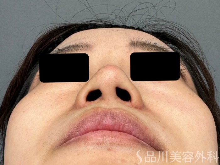 症例NO.74882のAFTER写真
