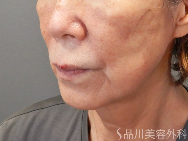 症例NO.73193のAFTER写真