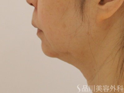 症例NO.73443のAFTER写真