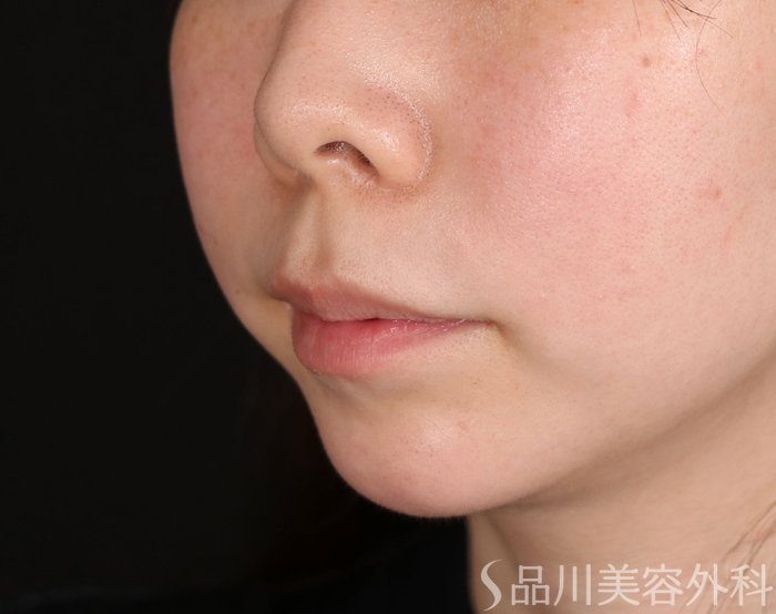 症例NO.74152のBEFORE写真