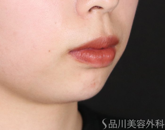 症例NO.73892のAFTER写真