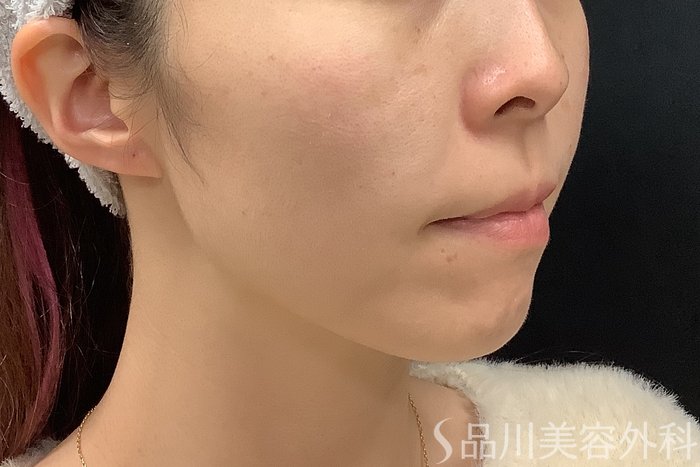 症例NO.69560のAFTER写真
