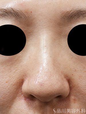 症例NO.75176のAFTER写真