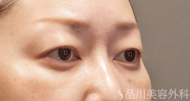症例NO.74956のAFTER写真