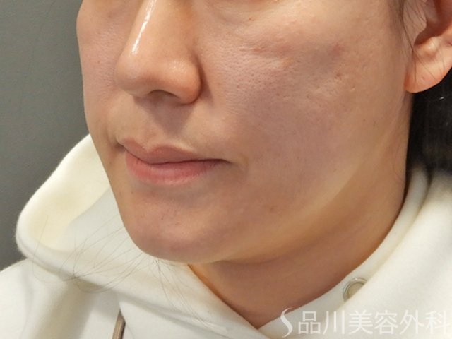 症例NO.75065のBEFORE写真