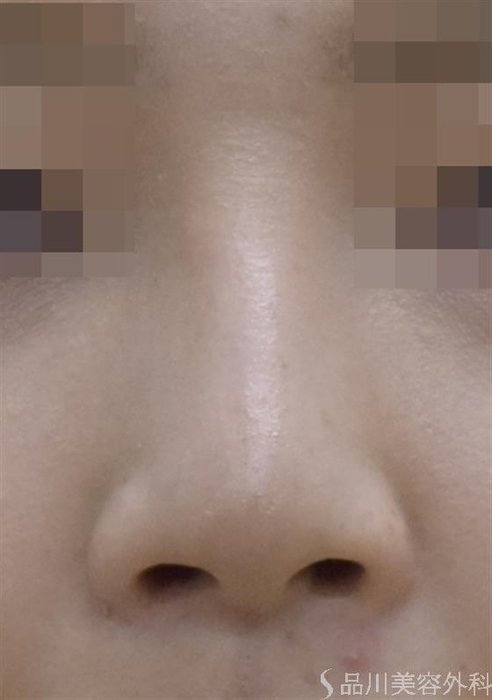 症例NO.51176のAFTER写真