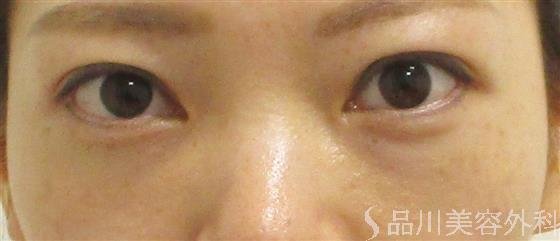 症例NO.55385のAFTER写真