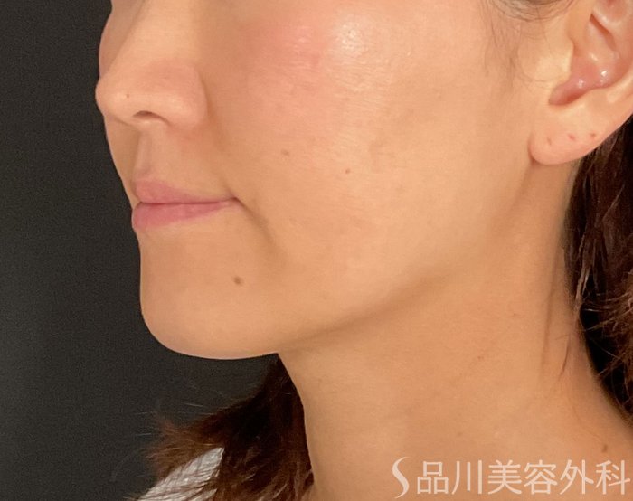 症例NO.74489のBEFORE写真