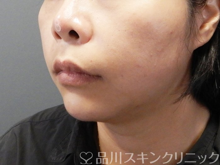 症例NO.72381のAFTER写真