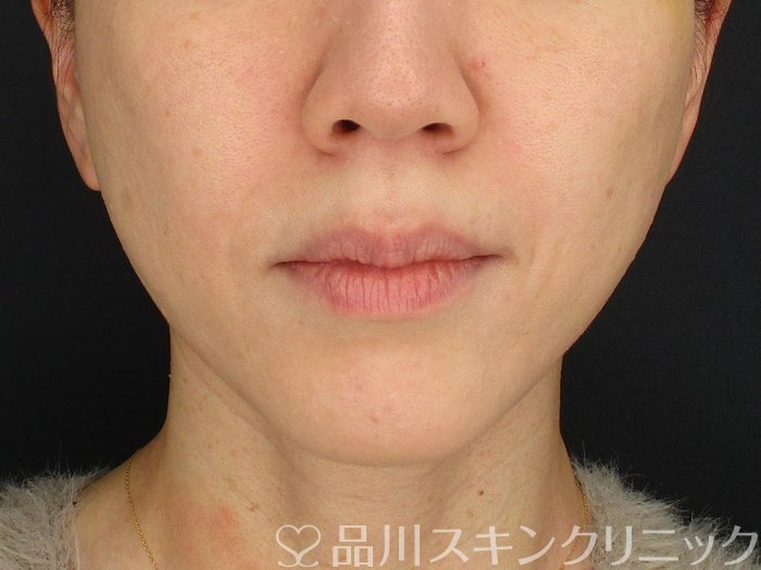 症例NO.67083のAFTER写真