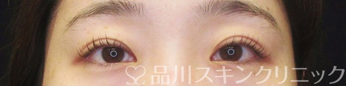 症例NO.67743のAFTER写真