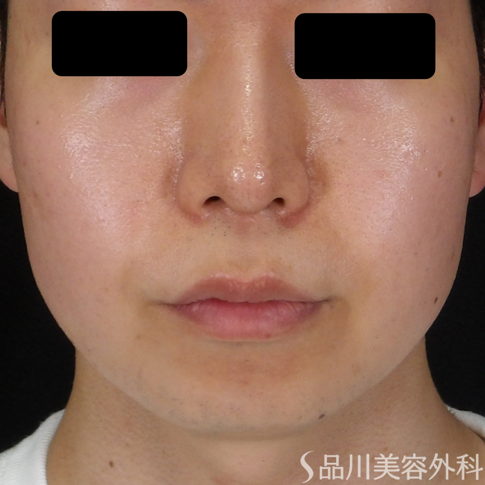 症例NO.71589のBEFORE写真