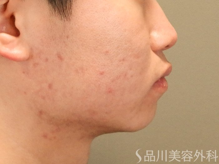 症例NO.69588のBEFORE写真