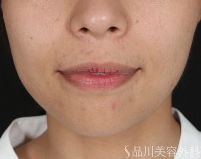 症例NO.71700のBEFORE写真