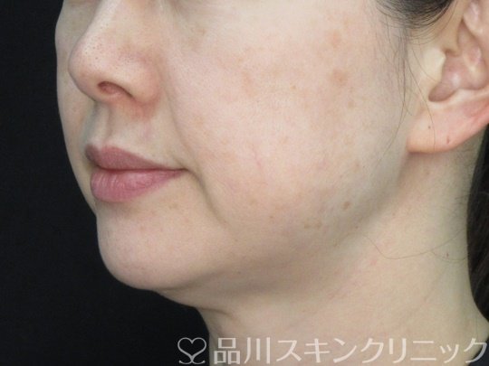 症例NO.72425のBEFORE写真