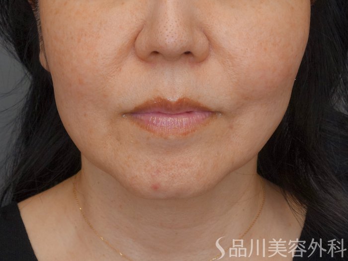 症例NO.72942のBEFORE写真