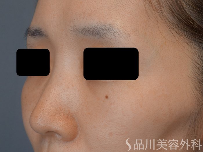 症例NO.73940のAFTER写真
