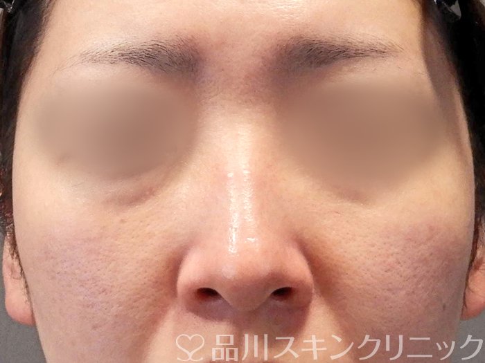 症例NO.65543のBEFORE写真