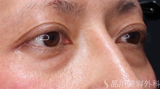 症例NO.60875のBEFORE写真
